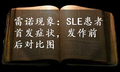 雷诺现象：SLE患者首发症状，发作前后对比图