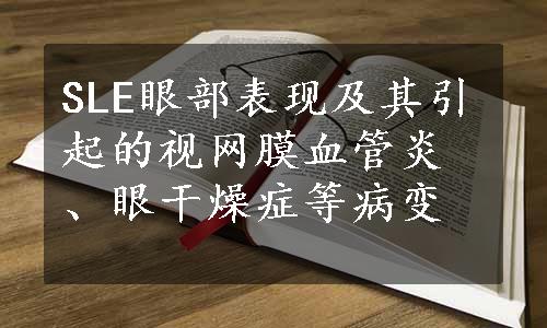 SLE眼部表现及其引起的视网膜血管炎、眼干燥症等病变